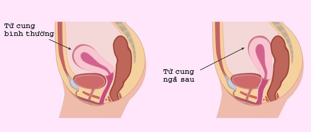 Tử cung ngả sau